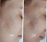 پکیج ضدلک و روشن کننده وی آی پی کره ای(یه روتین عالی و بدون نقص برای داشتن یه پوست شیشه ای)
