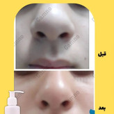 ژل کوچک کننده بینی گامنو مخصوص بینی های گوشتی