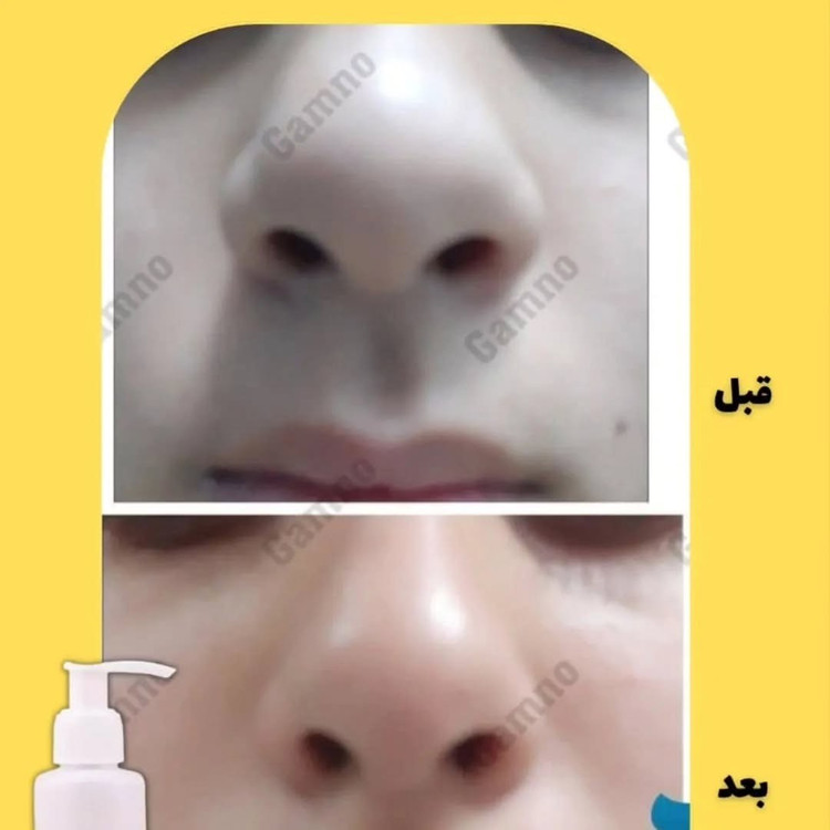ژل کوچک کننده بینی گامنو مخصوص بینی های گوشتی