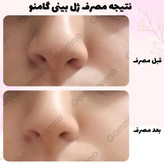 ژل کوچک کننده بینی گامنو مخصوص بینی های گوشتی